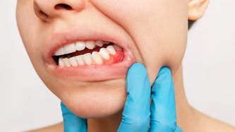 Aft Nedir? Aft Nasıl Geçer?