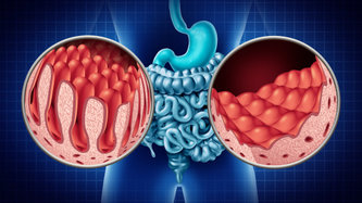 Bağırsak Düğümlenmesi Nedir? Belirtileri ve Tedavisi
