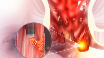 Basur (Hemoroid) Ameliyatı ve Ameliyat Sonrası Yaşam 