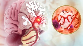 Beyin Tümörü Belirtileri ve Tedavi Yöntemleri