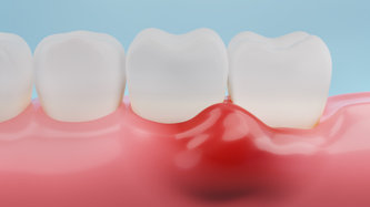 Diş Eti Şişmesi Nedir? Diş Eti Şişmesi Neden Olur?