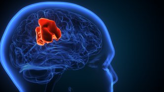 Glioblastom (GBM) Nedir? Glioblastoma Belirtileri Nelerdir?