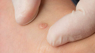 Kanserli Yağ Bezesi Belirtileri Nelerdir?