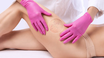 Kılcal Damar Tedavisi Nedir? Nasıl Yapılır?