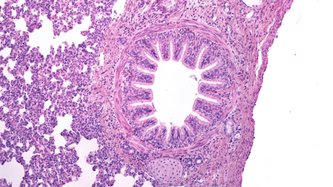 Kordoma Nedir? Belirtileri ve Tedavisi
