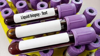 Likit Biyopsi Nedir? Likit Biyopsi Nasıl Yapılır?