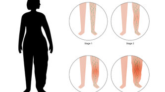 Lipödem Nedir? Lipödem Belirtileri ve Tedavisi