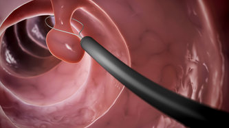 Polip Nedir? Polip Belirtileri ve Tedavi Yöntemleri Nelerdir? 