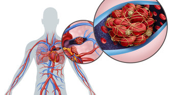 Pulmoner Emboli : Nedir, Belirtileri, Teşhis ve Tedavisi