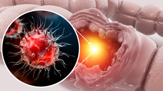 Rektum Kanseri Nedir? Rektum Kanseri Belirtileri Nelerdir? 