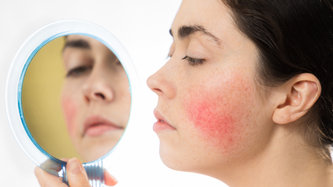 Gül Hastalığı Nedir? Gül Hastalığı Neden Olur?