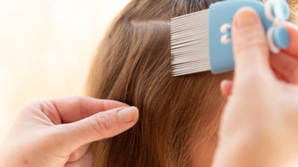 Saç Biti Nedir? Saç Biti Nasıl Geçer?