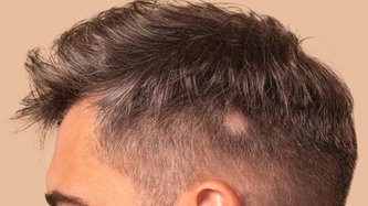 Saçkıran Nedir? Saçkıran Belirtileri ve Tedavisi