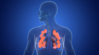 Sarkoidoz Nedir? Sarkoidoz Belirtileri Nelerdir?