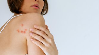 Tahta Kurusu Nedir? Tahta Kurusu Isırığı Nasıl Geçer?