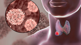 Tiroid Kanseri Nedir? Tiroid Kanseri Belirtileri Nelerdir?