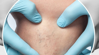 Varis Nedir? Varis Neden Olur? Belirtileri ve Tedavisi