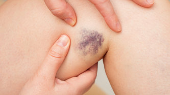 Vücutta Morarma Neden Olur? Morarmaya Ne İyi Gelir?