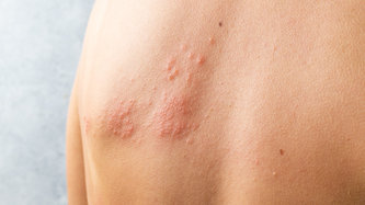 Zona (Gece Yanığı) Nedir? Zona Belirtileri ve Tedavisi